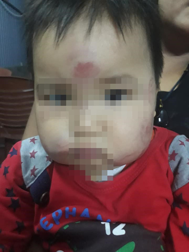 Cụ thể trên trang cá nhân của mình, nickname T.M.H đã chia sẻ những hình ảnh con trai mình sau khi đi nhà trẻ về thì xuất hiện những vết bầm tím phần mặt cho tới các bộ phận trên cơ thể như chân, tay. Cụ thể, lần đầu tiên chị H phát hiện những vết bầm tím trên người con vào ngày 19/10.