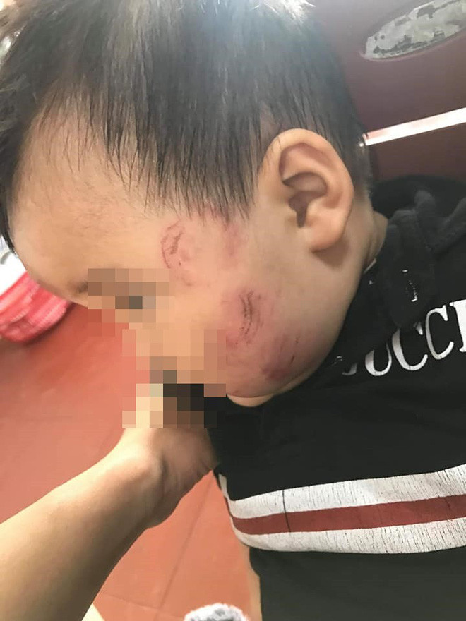 Nickname Minh Huế chia sẻ: "Nhìn con mà xót thế. Mình cũng trong giai đoạn có con đi mẫu giáo mà nhìn vào đây mà mất hết niềm tin để giao con cho các cô. Cần lắm các cơ quan chức năng vào cuộc để làm sáng tỏ sự vụ".