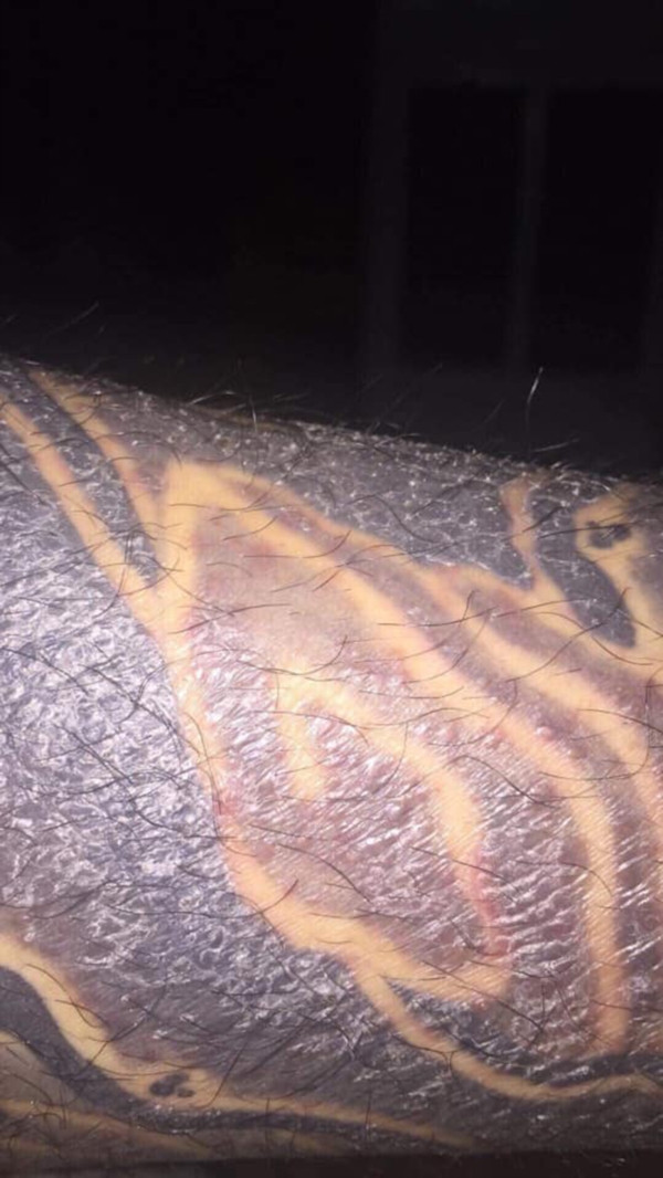 Mới đây, vụ việc có đến 16 vị khách hàng xăm hình bị nhiễm trùng, mưng mủ, thậm chí là hoại tử khi xăm mình tại một cửa hàng đã thu hút sự chú ý của đông đảo cư dân mạng.