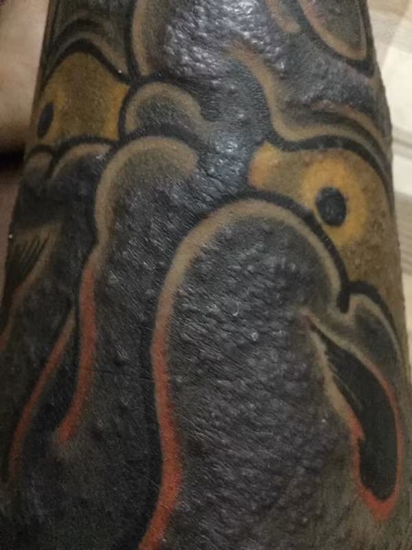 Sau khi phát hiện những kích ứng trên da, cả 16 khách hàng đều đã khi khám da liễu nhưng chưa thể chữa khỏi dứt điểm được. Mặc dù những khách bị nhiễm trùng nặng và hoại tử đã điều trị đỡ và đang trong quá trình hồi phục nhưng vẫn chưa lành hoàn toàn 100%.