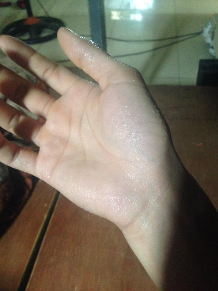 Việc đổ mồ hôi tay, chân cả mùa hè lẫn mùa đông khiến nhiều người mắc phải cảm thấy rất khó chịu. Tuy không nguy hiểm nhưng nó khiến nhiều người cảm thấy khó chịu và khá bất tiện mỗi khi phải giao tiếp với người khác.