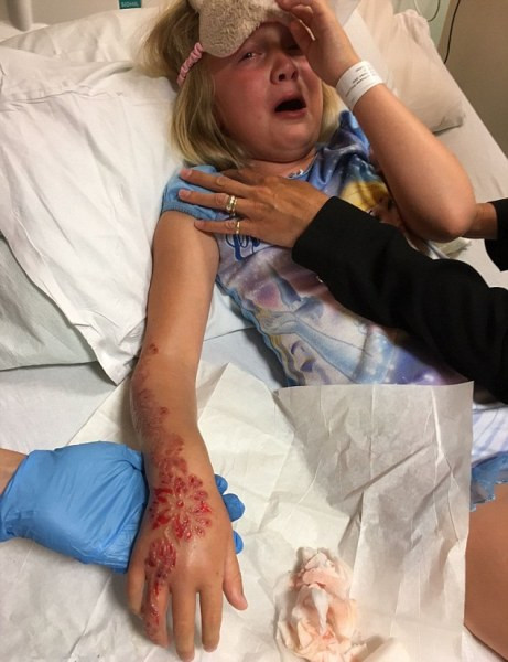 Báo chí đã từng đưa tin về trường hợp một câu bé 4 tuổi người Anh đã bị phỏng rộp sau khi xăm một bông hoa đỏ Hennan từ một nghệ nhân đường phố trong một lần đi du lịch cùng gia đình. Bác sĩ nhận định rằng cậu bé bị phản ứng với thành phần thuốc nhuộm nên làn da bị phồng rộp và có dấu hiệu rỉ máu.