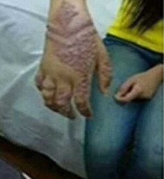 Mới đây, một cô gái trẻ ở Malaysia đã phải nhận cái kết không thể kinh hoàng hơn vì nghiện xăm henna. Cách đây vài tuần cô gái này đã đi xăm henna nhưng chỉ sau vài ngày nhận thấy tay đỏ rát phồng rộp.