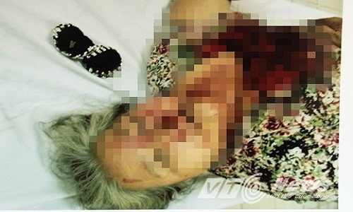 Cụ bà bị du côn đánh đến gãy răng, gãy quai hàm.