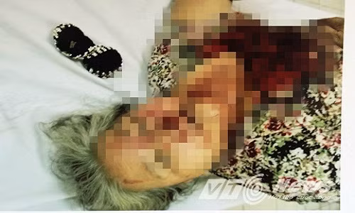 Cụ bà bị du côn đánh đến gãy răng, gãy quai hàm.