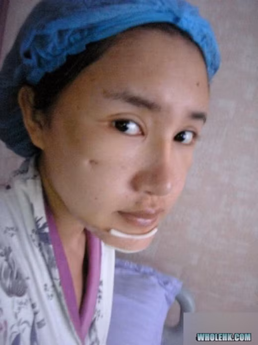 Sau một thời gian hoàn tất ca phẫu thuật làm đẹp, khuôn mặt của cô gái trên đã được cải thiện khá đáng kể.