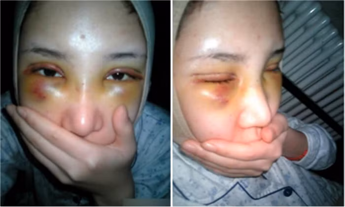 Đầu tiên cô gái này đã phải gọt đi phần gò má của mình để cho có một khuôn mặt gọn gàng. Sau khi thực hiện bức phẫu thuật này, mặt của cô gái người Trung Quốc đã trở nên phù nước và môi của cô bị rộp.