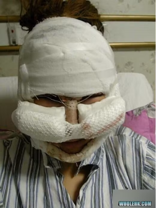 Sau khi công đoạn gọt má cô gái người Trung Quốc trên đã đặt định dạng định hình lại khuôn mặt của mình