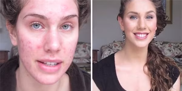 Các cô nàng thì chẳng ai muốn sở hữu khuôn mặt đầy mụn đỏ lốm đốm. Đây là nguyên nhân khiến các nàng mất đi sự tự tin của mình. Vì vậy mà họ nhờ cậy đến những loại mỹ phẩm để che những khuyết điểm này trên gương mặt mình.