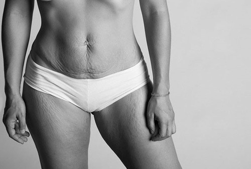 Những vết rạn cơ thể trong những lần "mang nặng đẻ đau" đều rất đẹp.