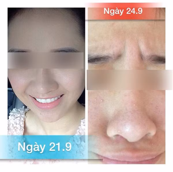 Trước đó, có không ít trường hợp dùng mĩ phẩm handmade, kem trộn, kem đông y hoặc tự dưỡng da theo kinh nghiệm truyền tai để lại hậu quả rất nặng nề.