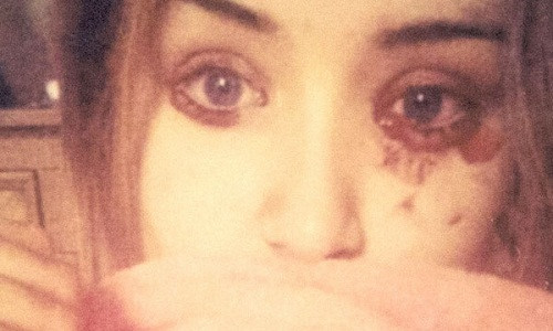 Marnie Harvie mắc bệnh lạ chảy máu mắt, tai 5 lần mỗi ngày/