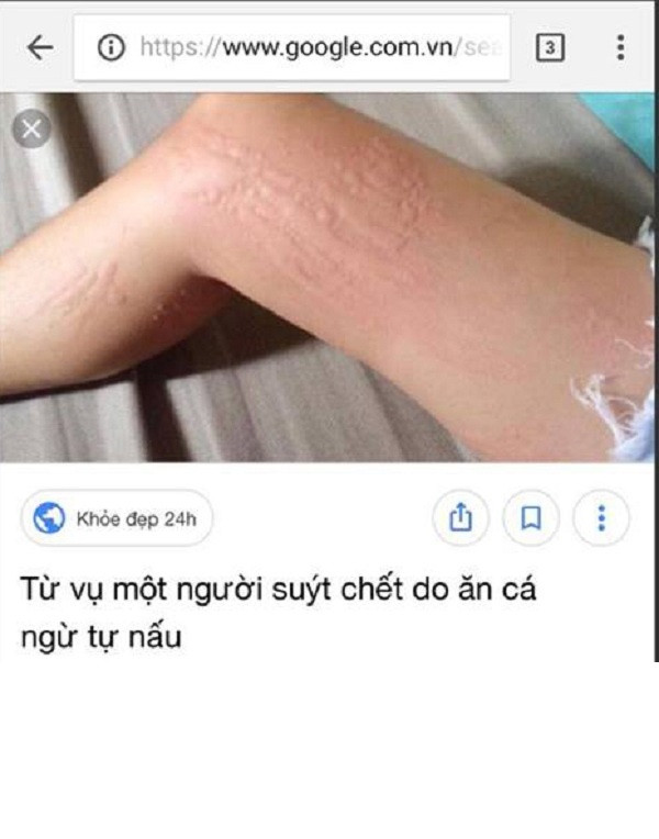 Hot girl scandal Thúy Vi, vừa bị hàng loạt khách hàng lên tiếng tố bán kem tắm trắng kém chất lượng làm hại da người sử dụng, khiến dư luận không khỏi xôn xao. Cụ thể, một tài khoản Facebook có tên D. đã đăng tải lên mạng xã hội hình ảnh tay và chân bị nổi mề đay sau khi sử dụng sản phẩm mua từ hãng kem của cô gái Cà Mau.