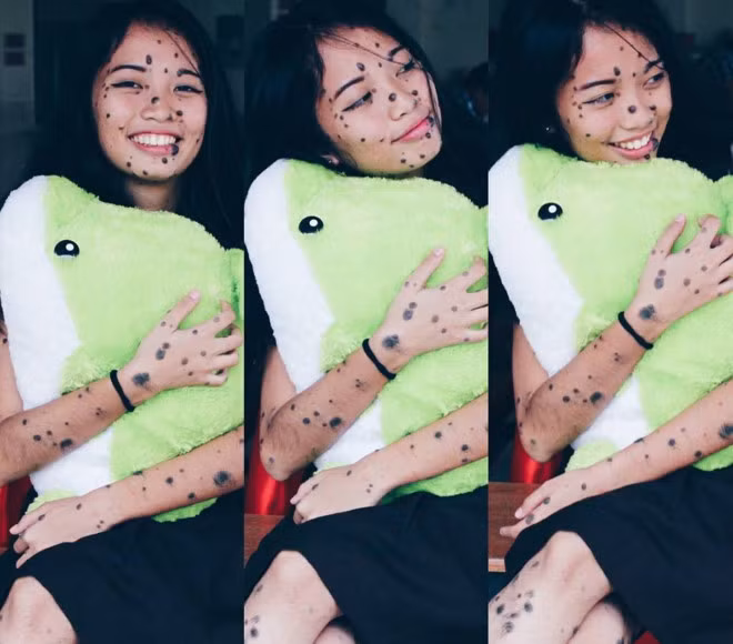 Evita hiện có gần 40.000 fan trên Instagram. Nhiều người trong số đó nói rằng "cô gái trăm nốt ruồi" này là thần tượng, nguồn cảm hứng giúp họ cố gắng hơn trong cuộc sống.