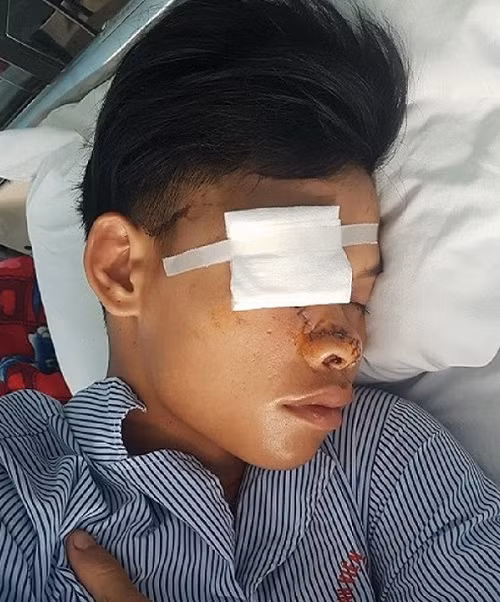 L. bị chém vỡ mặt và đứt một phần mũi. (Ảnh: T.A.D)