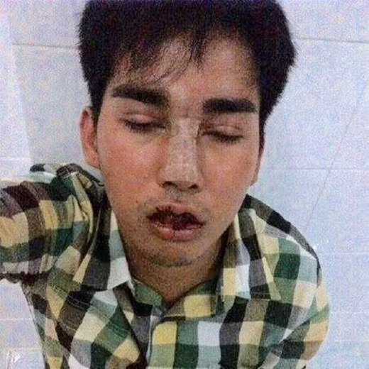 Công đoạn đầu tiên mà chàng trai xấu xí người Thái này làm để "đại tu" sắc đẹp của mình đó là tìm đến một nha sĩ để chỉnh lại hàm răng "thỏ". Sau một thời gian niềng răng, Palm đã có thể tự tin nở nụ cười tươi tắn.