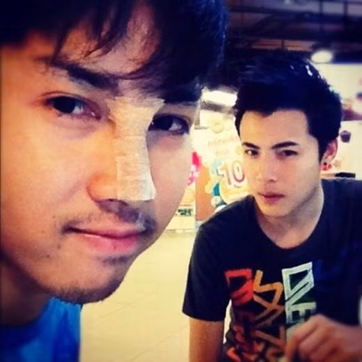 Bộ phận tiếp theo mà Palm chỉnh sửa đó là phần mũi, chàng trai này đã nhờ đến bác sĩ phẫu thuật thẩm mỹ giúp cánh mũi của mình có thể gọn gàng hơn so với trước đây.