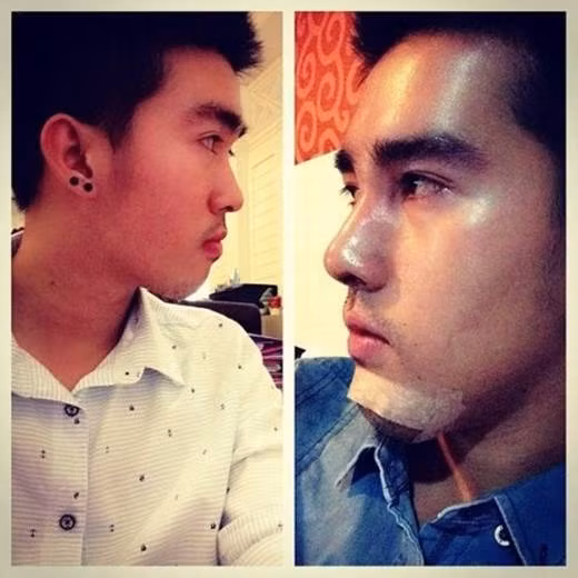 Trước và sau khi chàng trai xấu xí người Thái tiến hành phẫu thuật gọt cằm.