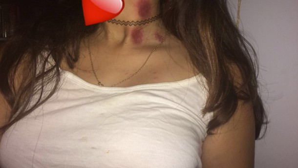 "Cắn yêu" hay nụ hôn hickey là nụ hôn táo bạo và mạnh mẽ khiến đối phương cảm thấy hơi đau đớn. Thông thường, dấu tích của vết sẽ tự mất đi sau 2 tuần nhưng nếu kéo dài lâu hơn (tới cả tháng).