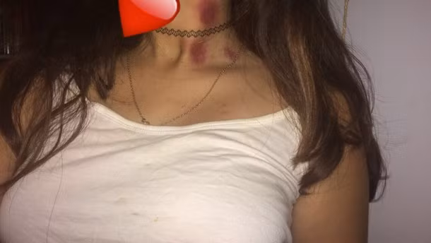 "Cắn yêu" hay nụ hôn hickey là nụ hôn táo bạo và mạnh mẽ khiến đối phương cảm thấy hơi đau đớn. Thông thường, dấu tích của vết sẽ tự mất đi sau 2 tuần nhưng nếu kéo dài lâu hơn (tới cả tháng).