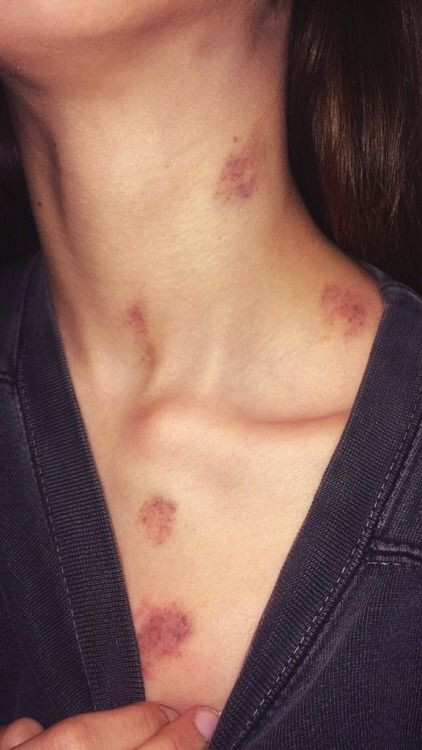 Trên thế giới, không ít những ca tử vong sau khi cùng người yêu kiểu hickey. Nguyên nhân được cho là một cục máu đông từ vết cắn đã di chuyển lên não, làm vỡ mạch máu não.