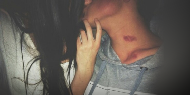 Theo miêu tả của các cặp đôi yêu nhau, Hickey Kiss người kia sẽ tác động lên vùng da của đối phương trong một thời gian dài, khiến vùng da đó bị ửng đỏ.