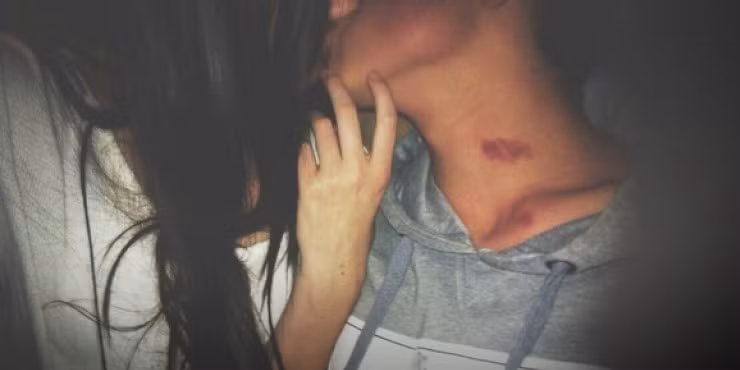 Theo miêu tả của các cặp đôi yêu nhau, Hickey Kiss người kia sẽ tác động lên vùng da của đối phương trong một thời gian dài, khiến vùng da đó bị ửng đỏ.