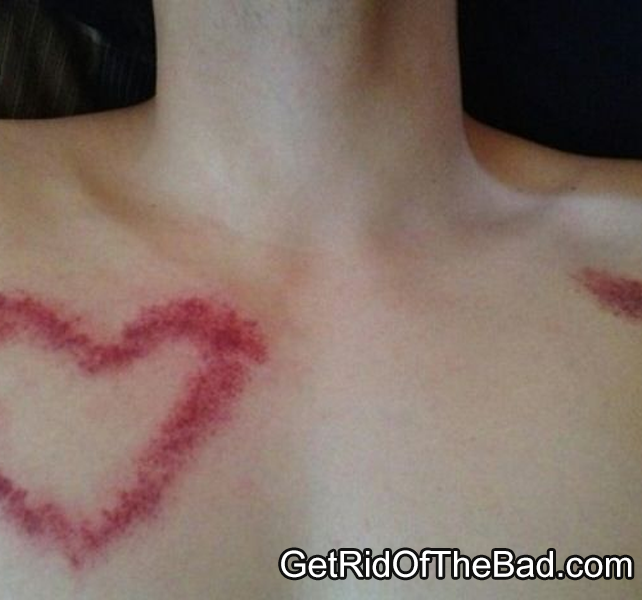 Vết bầm tím là một chấn thương da phổ là điều xuất hiện sau khi các cặp đôi chạy theo trào lưu hôn hickey.