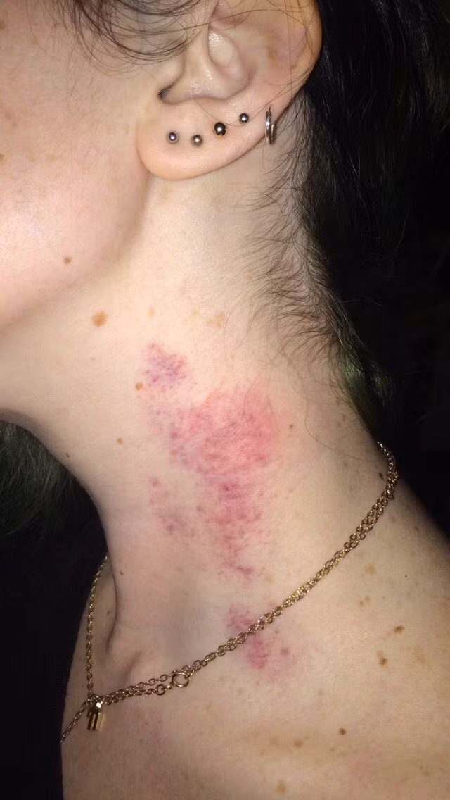Hình ảnh sau màn hickey kiss đáng sợ của các bạn trẻ.
