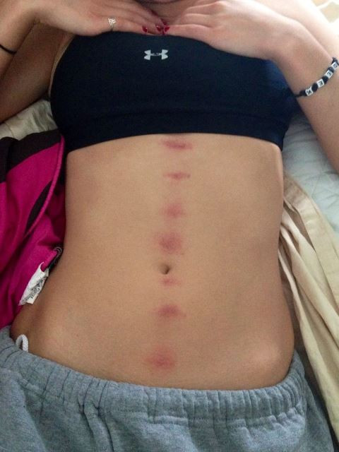 Nhiều bạn trẻ còn khoe chiến tích hôn kiểu Hickey Kiss tạo theo những hình thù như trái tim hay vết cắn như ma cà rồng trên mạng xã hội và nó từng một thời trở thành trào lưu của việc khoe có người yêu.