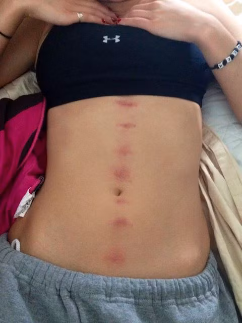 Nhiều bạn trẻ còn khoe chiến tích hôn kiểu Hickey Kiss tạo theo những hình thù như trái tim hay vết cắn như ma cà rồng trên mạng xã hội và nó từng một thời trở thành trào lưu của việc khoe có người yêu.