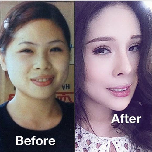 Đầu tháng 2/2014, giới trẻ Hà thành xôn xao về thông tin một cô gái đã từng dũng cảm trải qua 12 lần dao kéo để sở hữu nhan sắc như ý muốn. Đó chính là chuyên gia trang điểm Tina Lê. Người đẹp Hà thành từng tiết lộ, lần đầu tiên cô đi chỉnh sửa mũi tại Bệnh viện 108. Sau đó, Tina Lê tiến hành gọt cằm, bơm môi và gọt hàm. Chuỗi thời gian này, cô đã phải chịu đựng rất nhiều đau đớn khổ sở.