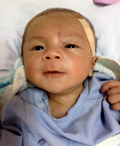 Vết sẹo khá dài do lưỡi dao quá lớn vẫn còn để lại trên gương mặt Dương Minh Phát và mọi di chứng vẫn có thể còn chờ bé ở phía trước. Tuy nhiên hiện tại, đây được xem là "kỳ tích" trong việc cứu sống bé sơ sinh 11 ngày tuổi bị tổn thương não của ngành y học Việt Nam.