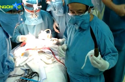 Tuy nhiên may mắn mỉm cười, sau thời gian chuẩn bị, thời khắc nín thở đã diễn ra và mọi thứ hoàn toàn suôn sẻ. Thạc sĩ - bác sĩ Đào Trung Hiếu, phó giám đốc bệnh viện Nhi Đồng 1 đã từ từ dùng một tay cầm cán dao rút con dao ra khỏi đầu bé. Phòng mổ im phăng phắc bắt đầu có những tiếng thở phào. Việc rút dao chỉ diễn ra khoảng 5 phút.