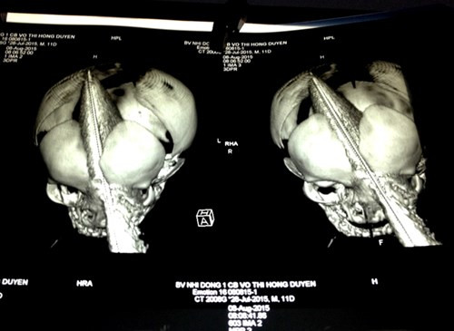 Chẩn đoán hình ảnh, kết quả cho thấy nạn nhân bị lưỡi dao dài 26 cm đâm xuyên từ hốc mắt trái lên đến đỉnh não phải. Phần lưỡi dao xuyên sọ và đi vào não dài 11 cm gây tổn thương toàn bộ mô não nơi nó đi qua. Đây là phần não giữ nhiệm vụ điều khiển vận động của cơ thể.