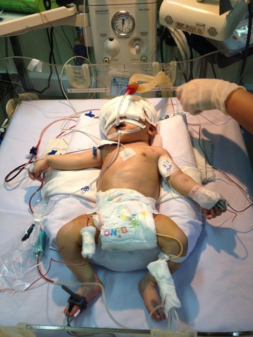 Lo lắng được đổ dồn vào việc bé có thể bị nhiễm trùng và đột tử bất cứ lúc nào bởi lưỡi dao quá to lại bẩn. Nỗi lo càng chồng chất khi một ngày sau mổ, não của bé có hiện tượng xuất huyết từ vết thương. Bé trai 11 ngày tuổi được theo dõi đặc biệt, vừa cho thở máy, vừa truyền dịch nuôi sống qua tĩnh mạch, vừa dùng những loại thuốc chống nhiễm trùng.