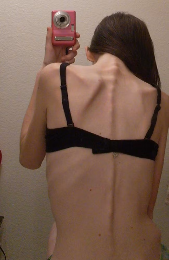 Được biết, ban đầu hai chị em người Mỹ này , cạnh tranh nhau xem ai sẽ gầy hơn. Mỗi ngày họ chỉ nạp vào cơ thể 350 calo và tập thể dục liên tục trong nhiều giờ. Chỉ trong một thời gian ngắn, Courtney bắt đầu đi đến giới hạn quá sức chịu đựng của cơ thể.