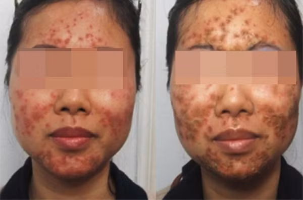 H.O bị xuất huyết dưới da, phá vỡ tĩnh mạch máu tại chỗ và có nguy cơ chết da vĩnh viễn, không thể phục hồi. Cô gái trẻ sau đó tốn rất nhiều tiền cho các biện pháp trị liệu tại bệnh viện.