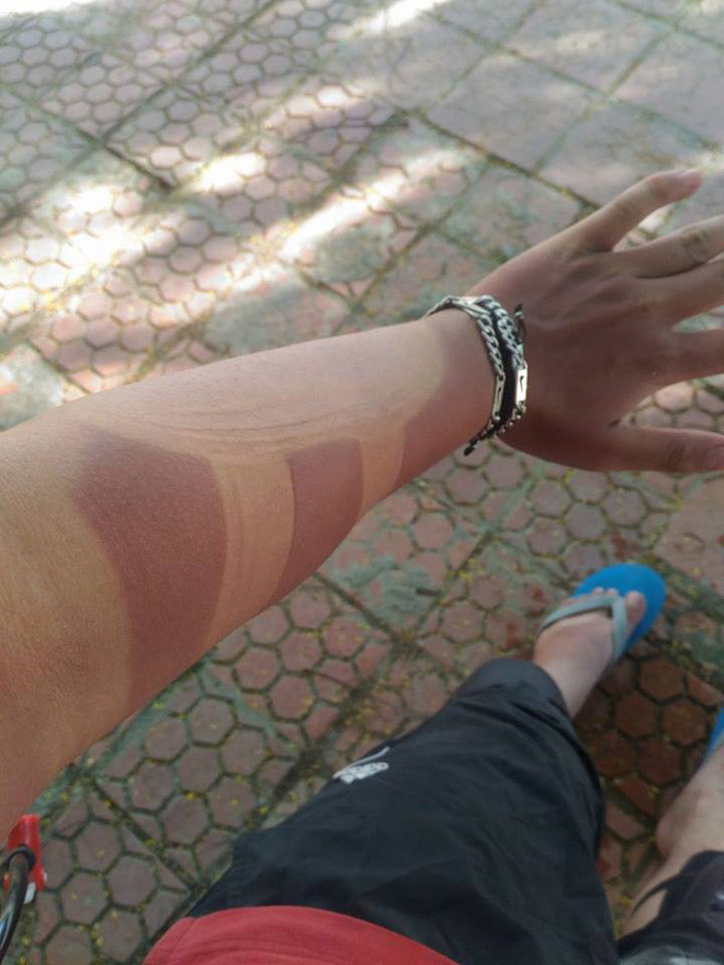 Ngay sau khi những loạt ảnh cháy nắng đã được dân mạng nhận được sự đồng cảm của nhiều người xem.