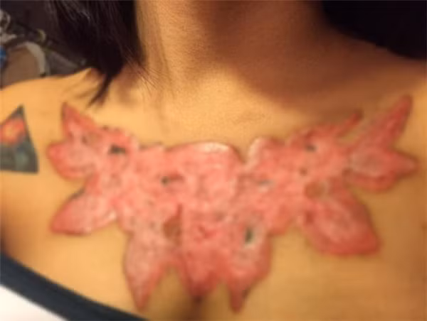 Bây giờ, hình xăm của Pasuda đã liền sẹo và được loại bỏ hoàn toàn nhưng trên người cô vẫn còn để lại vết sẹo lồi rất to và thiếu thẩm mỹ như thế này.