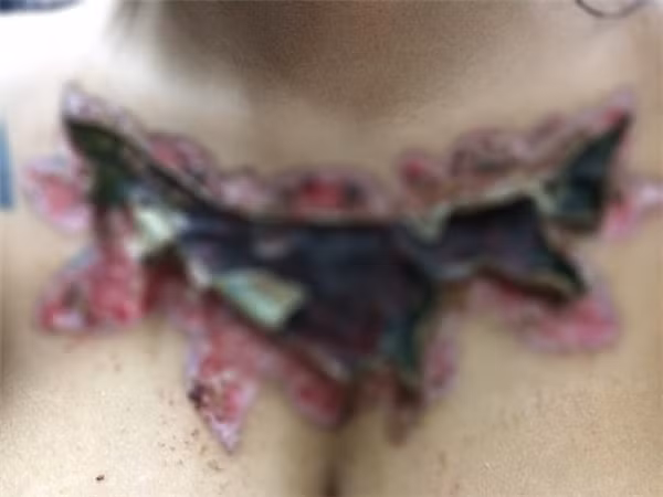 Cách mà cô gái người Thái Lan này lựa chọn để xóa hình xăm cũ có tên Rejuvi - một biện pháp hoá học được dùng trên da. Được biết, đây là phương pháp thay thế cho cách dùng tia laser thông thường.