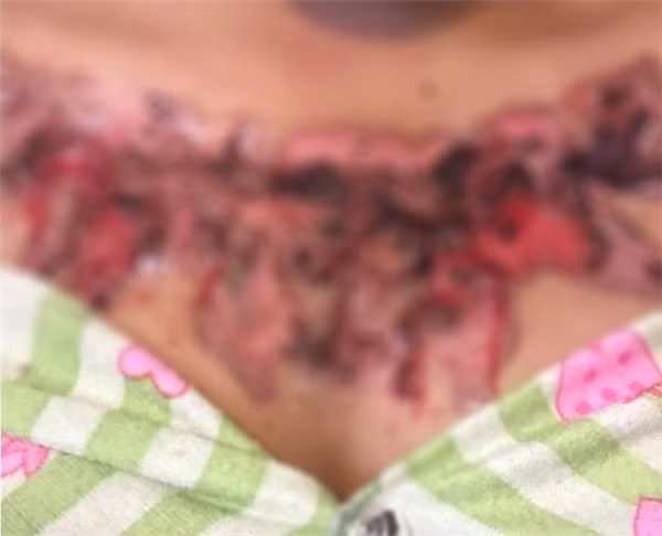 Tuy nhiên, sau khi dùng biện pháp này lên da, vết xăm của Pasuda bị ngứa và cứ đau nhức liên miên. Hai tháng sau, vết thương của cô gái này bắt đầu bị lở loét và có dấu hiệu bị nhiễm khuẩn trong rất ghê rợn.