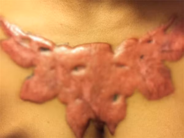 Đến nay, dù vết xăm đã được xoá sạch nhưng phần da của Pasuda cũng bị tổn thương nghiêm trọng.