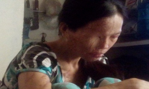 Khuôn mặt của chị bị biến dạng sau ca axit của người tình.