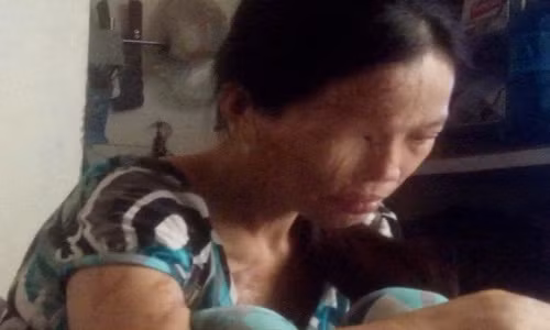 Khuôn mặt của chị bị biến dạng sau ca axit của người tình.