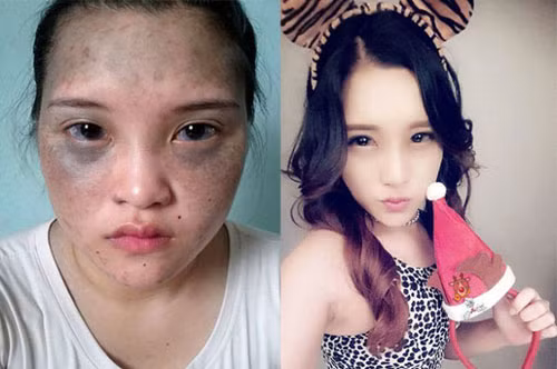 Trước khi thẩm mỹ, khuôn mặt của Lê Thị Hương Giang (20 tuổi, đến từ Hải Phòng có nhiều vết chàm lớn và mụn ruồi. Cô trở nên tự ti và sống khép mình. Sau nhiều tháng với 6 lần chỉnh sửa, Hương Giang đã có được khuôn mặt đẹp và cô tự tin theo đuổi giấc mơ ca sĩ.