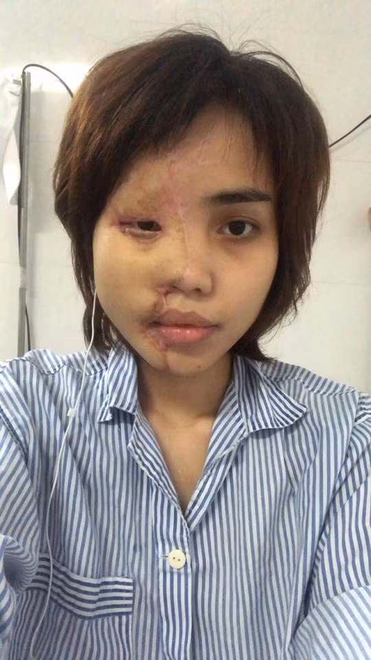 Theo chia sẻ của bác sĩ đều trị cho Lan Vy, cô gái bị chồng tương lai tạt axit này cũng là bệnh nhân đầu tiên của Việt Nam được áp dụng kỹ thuật vi phẫu tái tạo ngay lập tức khuôn mặt bỏng axit trong một lần mổ, kết quả đạt trên 90%.