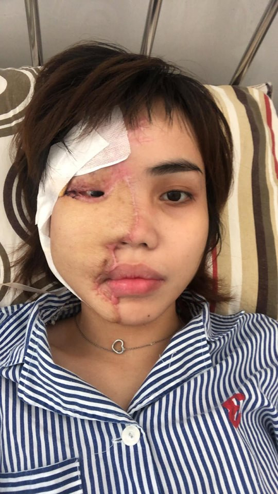 Khi đến BV, một nửa mặt trái của Vy đen xì, cháy xém, mắt trái không thể mở, chân tay cũng loang lổ vết bỏng axit. Từ đó, cô gái trẻ trải qua những tháng ngày đau đớn nhất cuộc đời khi axit ngấm sâu vào cơ thể, đến đâu thối thịt đến đó.