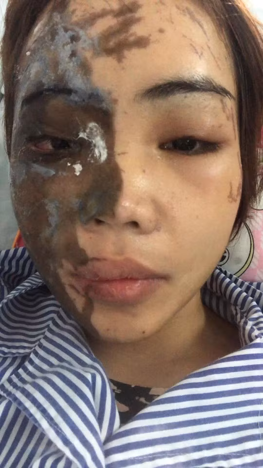 Lan Vy được tiến hành phẫu thuật vi phẫu để ắt hết tổ chức hoại tử, làm sạch axit còn tồn dư cho đến mô lành, đồng thời thiết kế vạt da siêu mỏng vùng lưng để tái tạo khuôn mặt.