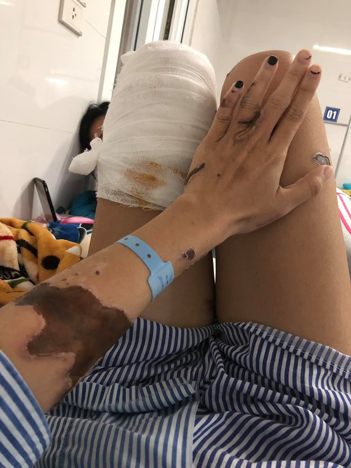 Sau thời gian, những vết bỏng axit trên da Lan Vy bắt đầu hồi phục.
